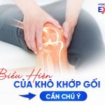 Cảnh Báo 5 Biểu Hiện Của Khô Khớp Gối Cần Chú Ý